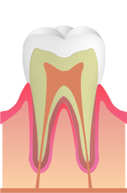 C0：虫歯の初期症状