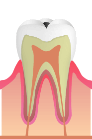 C1：虫歯がエナメル質に到達した状態