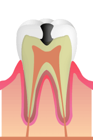 C2：虫歯が象牙質に到達した状態
