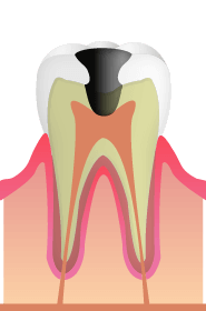 C3: 虫歯が神経に到達した状態