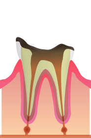 C4: 歯の根まで虫歯が到達した状態
